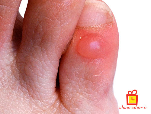 چه عوالی باعث ایجاد زخم پشت پا یا تاول زدن در اثر پوشیدن کفش و پیاده روی طولانی می شود؟ درمان تاول